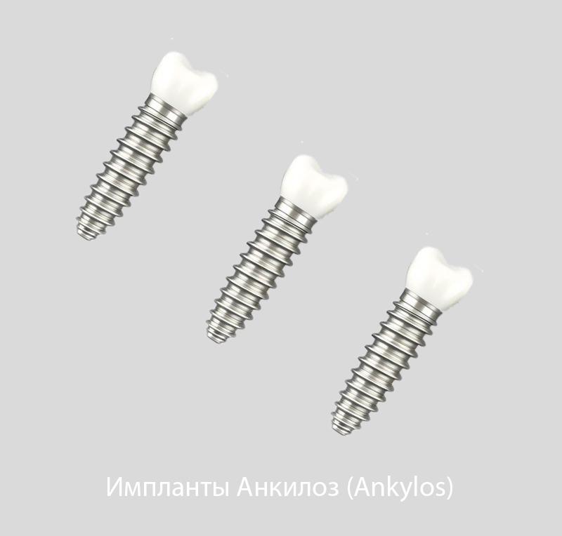 Импланты Анкилоз (Ankylos) Германия